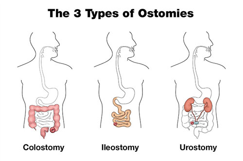 Making sure patients have the ostomy supplies they need - Wound Care Advisor