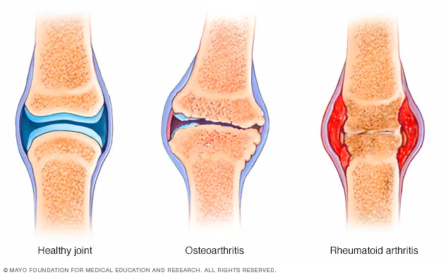 Joint protection for people with hand arthritis - Mayo Clinic