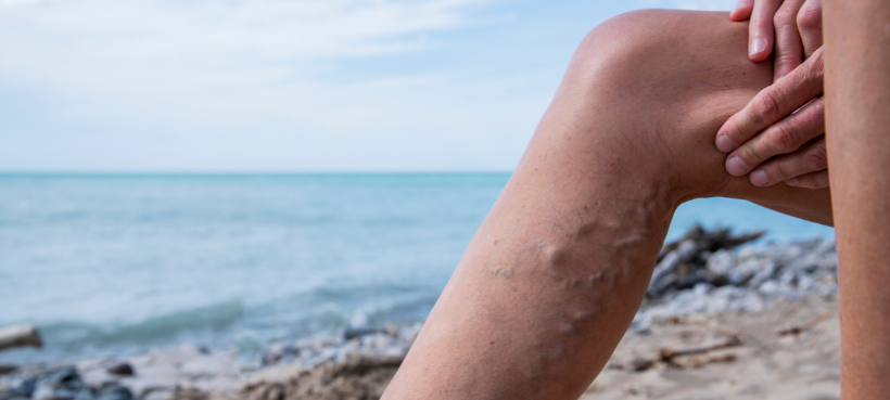 Varicose veins: What are they and what can you do about them?